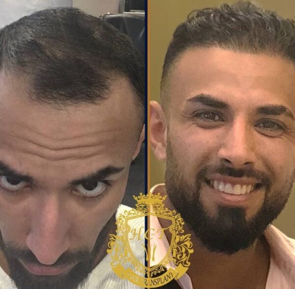Hair Transplant Before And After Photos In Turkey 76