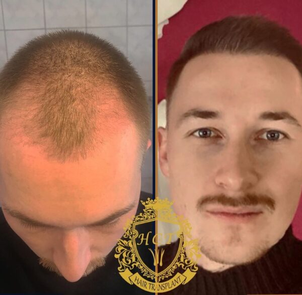 Hair Transplant Before And After Photos In Turkey 77
