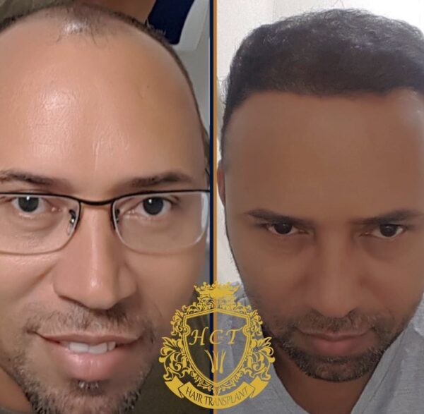 Hair Transplant Before And After Photos In Turkey 78