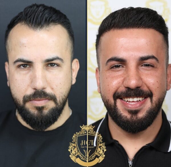 Hair Transplant Before And After Photos In Turkey 8