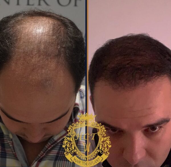 Hair Transplant Before And After Photos In Turkey 80