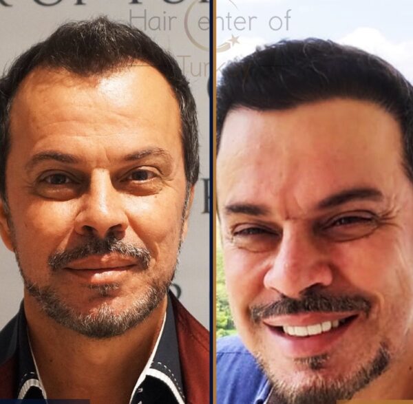 Hair-Transplant-Before-And-After-Photos-In-Turkey-81