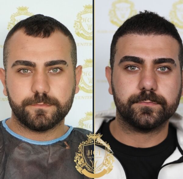 Hair Transplant Before And After Photos In Turkey 83