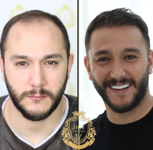 Hair Transplant Before And After Photos In Turkey 9