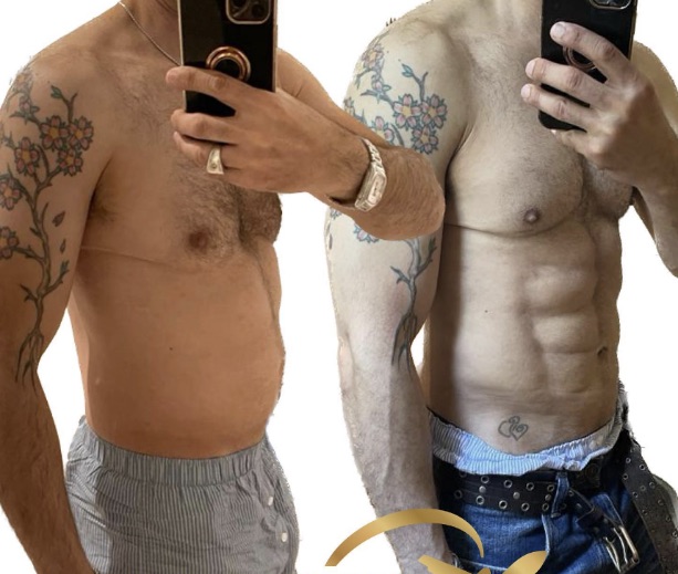 Six Pack Abs Surgery 3