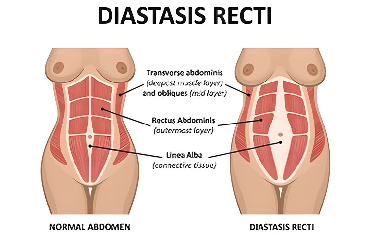 Abdominoplasty And Abdominal Muscle Repair Diastasis Recti