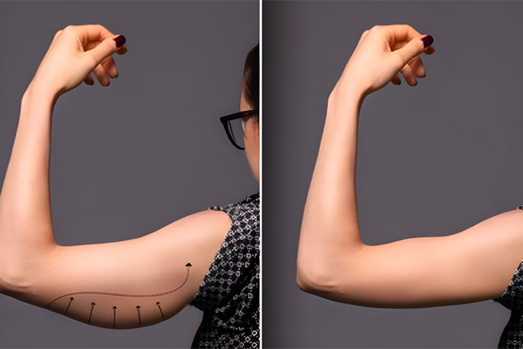 Nouvelle Announces New Arm Sleeves for Arm Lift Patients