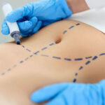 The Evolution Of Tummy Tuck Surgery Whats New In
