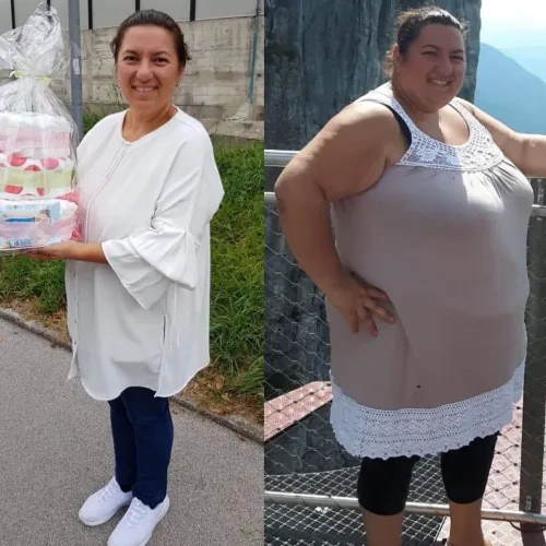 obesity surgery bariatric surgery turkey before and after photos