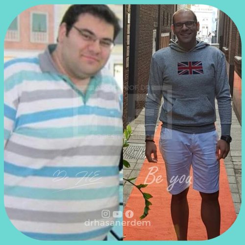 Obesity Surgery Bariatric Surgery Turkey Before And After Photos