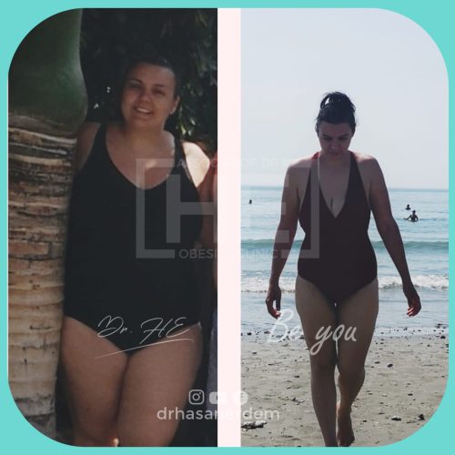 Obesity Surgery Bariatric Surgery Turkey Before And After Photos